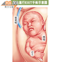 先在產婦腹部直切，用產鉗將男嬰頭部及右手抽出母腹外，為男嬰插氧氣喉才剪臍。
