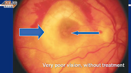 老年黃斑病變是長者常見眼疾。