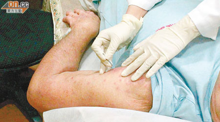 病人接受針刺，須留意消毒衞生。