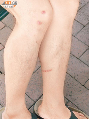 港漢展示腳部被毆傷痕。（黃智康攝）