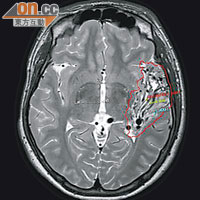 廿歲患者接受無框架立體定向放射手術前，腦部出現逾廿五毫升的血管叢。