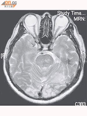 磁力共振顯示男病人兩側枕葉較淺色，表示該部分出現梗塞。