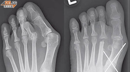 左圖：王女士拇趾外翻，第二趾被擠壓至脫骹。右圖：接受截骨手術後，問題得到改善。
