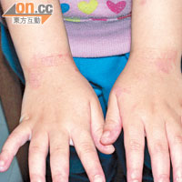 濕疹是兒童常有的皮膚問題，皮膚科醫生指只要使用得宜，類固醇可有效並安全地紓緩病情。