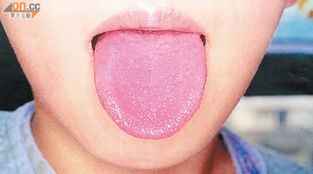本港猩紅熱個案近月上升，草莓舌是猩紅熱病徵之一。（資料圖片）