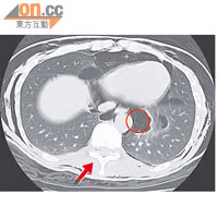 病人的電腦掃描圖片顯示，呈黑色部分（圓圈示）屬於積氣位置，椎管亦有一小點積氣（箭嘴示）。