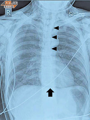 病人的胸部Ｘ光圖片中，上排三個小箭嘴顯示病人皮下氣腫及縱隔積氣的位置，下方箭嘴指向一條連接的橫線，也是縱隔積氣的迹象。（《香港急症醫學期刊》圖片）