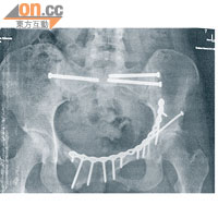 在X光片中，見到楨敏的盆骨鑲了十三支釘，另加兩塊鐵片，以整合及固定因被馬匹壓落她身體後弄碎了的骨。