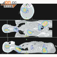 高速螺旋放射治療系統處理範圍覆蓋整個身軀，更可同時處理體內不同位置的腫瘤。