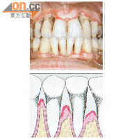 牙菌膜分泌有毒物質刺激牙齦組織引致牙周病。