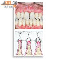 牙菌膜中細菌會分泌酸性物質腐蝕牙齒，引致蛀牙。
