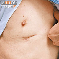 單孔微創胸腔鏡手術只有一個切口，創傷性較低。（受訪者提供）