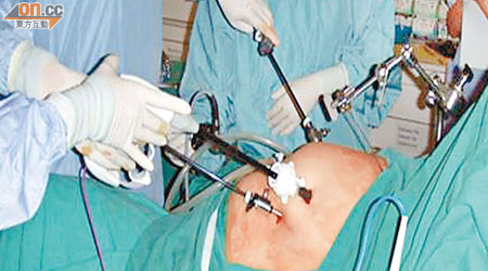 縮胃手術以微創方式進行，患者一般留醫三日可出院。