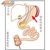 縮胃手術的原理是垂直切除「胃大彎」，以減少胃容量，剩下一個約150毫升的管狀胃囊。