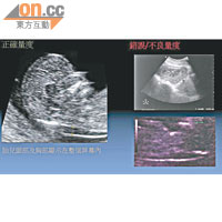 梁永昌指超聲波掃描胎兒頸部透明層厚度，如超過三毫米，代表胎兒較高風險患有唐氏綜合症。
