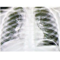 染病女童的肺部Ｘ光片。