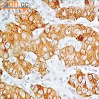 若使用免疫組織化學染色法（IHC）檢測，ALK所致的非小細胞肺癌便會呈現為啡色的斑點。