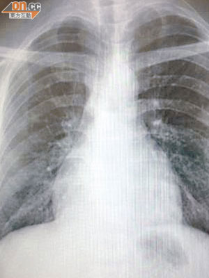接受抑制劑治療後，永根的肺部X光圖明顯較清晰，代表腫瘤已縮小。