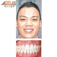 左先生完成療程後，牙齒回復整齊，不再有空隙。