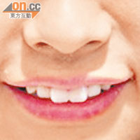 手術前<br>「八重齒」整容只需在犬齒上黐上小假牙，圖為手術前後的差別。（資料圖片）