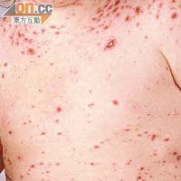 水痘患者會發燒及出紅疹