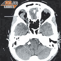 腦掃描顯示病人的腦靜脈位置。