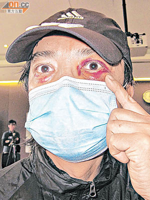 陳先生受襲後眼睛至今仍紅腫，幸無影響視力。