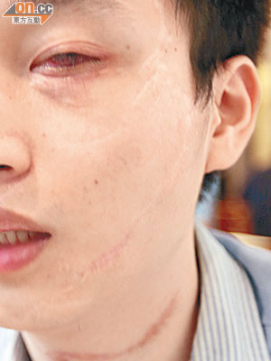 黃海城向記者展示頸上疤痕，並指左眼現時裝上人工眼珠。（朱先儒攝）