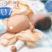 兩歲港童因不明肺炎入院，並有嚴重營養不良，體重僅５公斤，經檢查發現感染愛滋病毒。（受訪者提供）