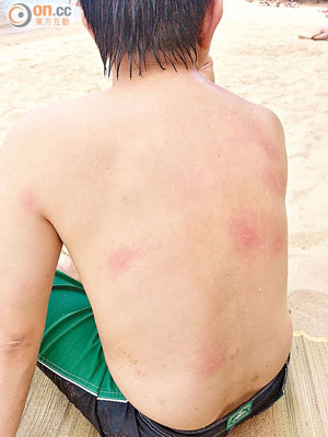 何先生日前在馬灣東灣逗留短短五分鐘，背部已被蚊子叮咬至多處紅腫。（讀者提供）