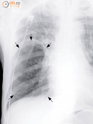肺部Ｘ光圖片可見，病人的右肺有個肺大疱（箭嘴示）。