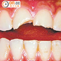 如「撞崩」牙，應把斷裂部分放入生理鹽水或牛奶等液體內保存。