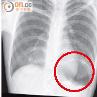 胸部X光檢查顯示胃部突出（紅圈示）。