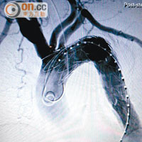 植入支架後，胸腔主動脈瘤明顯消失。