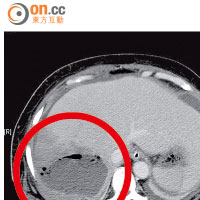 掃描顯示右肝（紅圈示）有清晰陰影，化膿部分直徑達十多厘米。(受訪者提供)