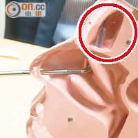 鼻竇球囊擴張術以類似「通波仔」形式，利用球囊（紅圈示）打通鼻竇管道。（張美蘭攝）