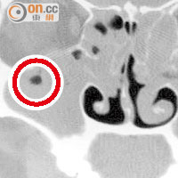 電腦掃描顯示，圖左（紅圈示）的鼻竇位置呈灰色，代表充斥膿液，圖右位置呈黑色即表示鼻竇健康。