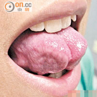 如舌繫帶過短，伸出的舌頭會因舌繫帶拉扯而呈W形。