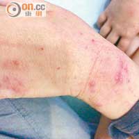 患濕疹男童塗抹椰子油後出現紅腫的過敏情況。（被訪者提供）