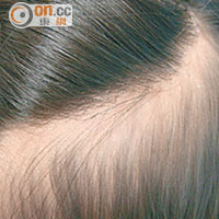 女童的後腦位置有嚴重脫髮，形成帶狀光禿。