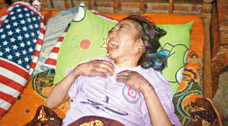 懷疑受虐的印傭Erwiana Sulistyaningsih目前在印尼一間醫院治理，狀甚痛苦。（互聯網圖片）