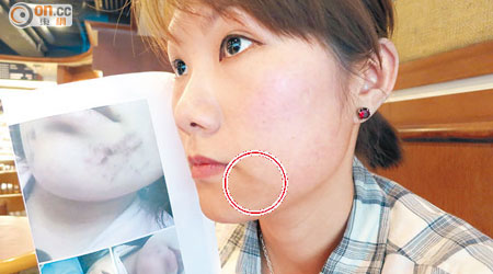 燒燶面<br>許小姐在首次接受面部彩光療程後，下巴有結痂情況，現康復仍留有紅印（圈示）。