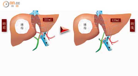ALPPS手術，先把右肝血管結紮（紅圈示），令血液只流向左肝，八日後左肝由331ml增至439ml。