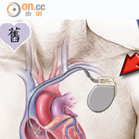 傳統心臟除顫器（箭嘴示）的電極線經過靜脈放進右心室及右心房，脈衝產生器則放在鎖骨以下的皮下位置。