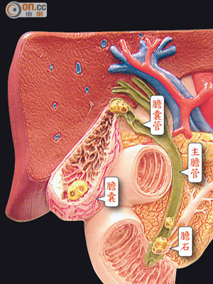 膽石可出現於膽囊、主膽管等多個位置。