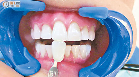 使用漂白劑過量易令牙肉變白，雙氧水更會「浸壞」牙肉導致萎縮。（被訪者提供）
