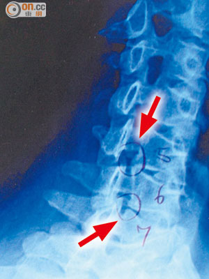 三十一歲男患者第五及六節脊椎神經孔（箭嘴示）壓至收窄。