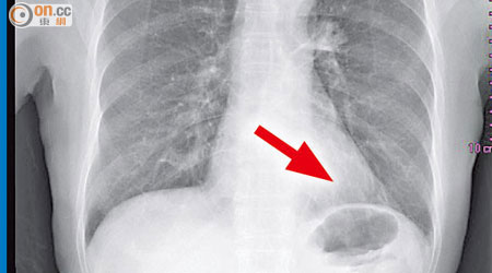 女病人肺部有腫瘤（箭嘴示），但威院指影像模糊，可能因此發現不到肺部陰影。