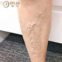 三期患者<br>病人的右腳小腿呈現蚯蚓般的血管。