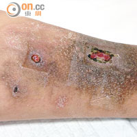 五期患者<br>五期患者的皮膚已潰瘍，傷口難以愈合。